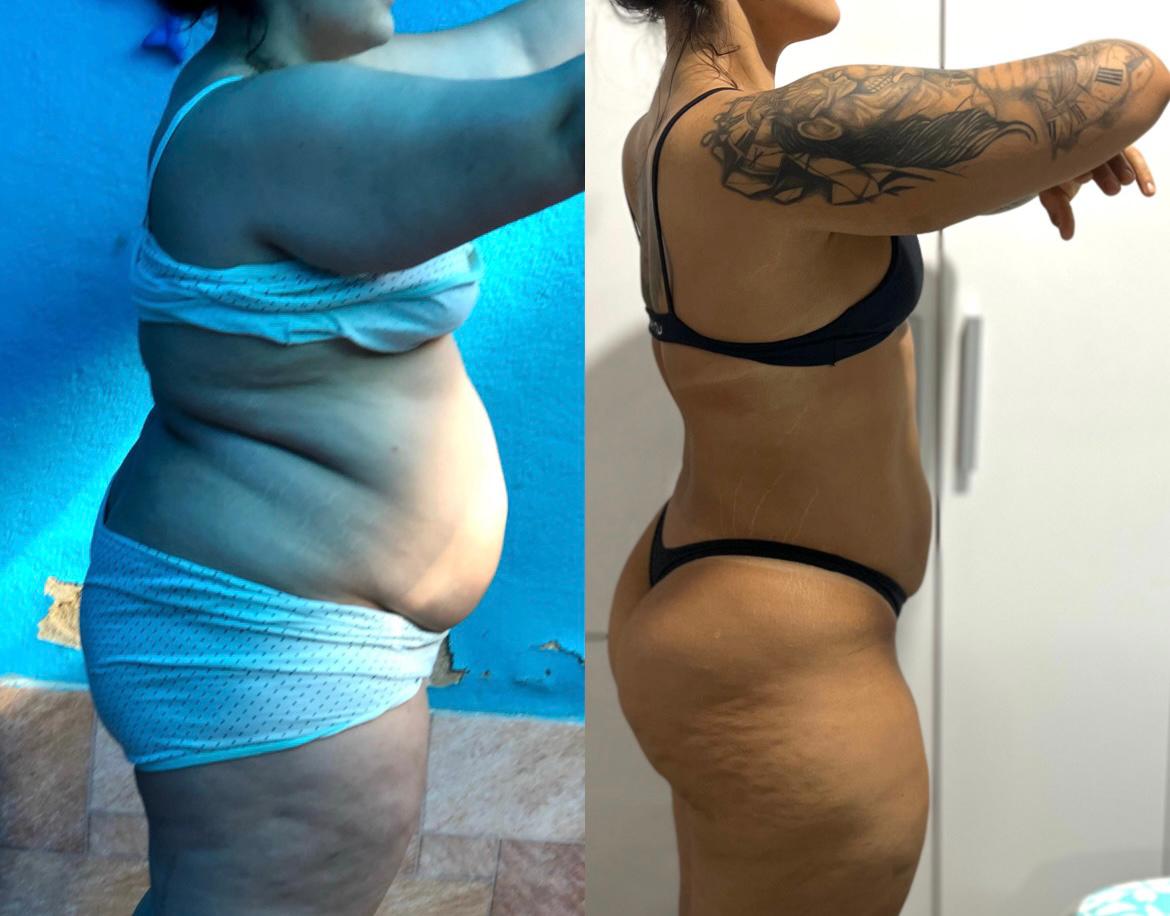 Antes e Depois 11